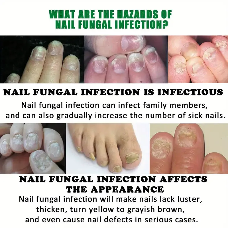 Ginger Nail Care Liquid Onychomycosis Fungus Repair Hand and Foot Nail Care