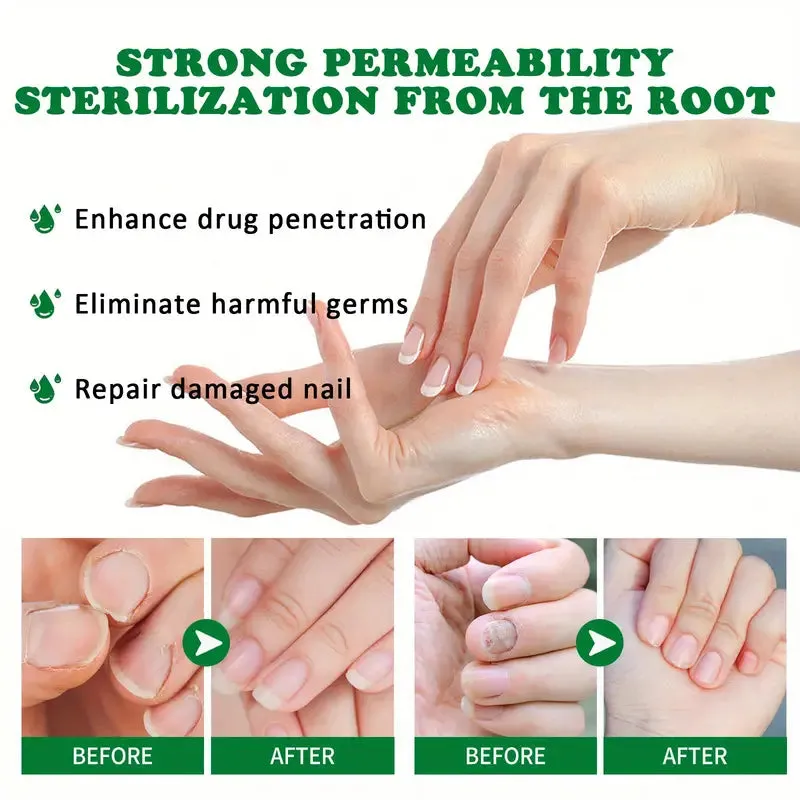 Ginger Nail Care Liquid Onychomycosis Fungus Repair Hand and Foot Nail Care