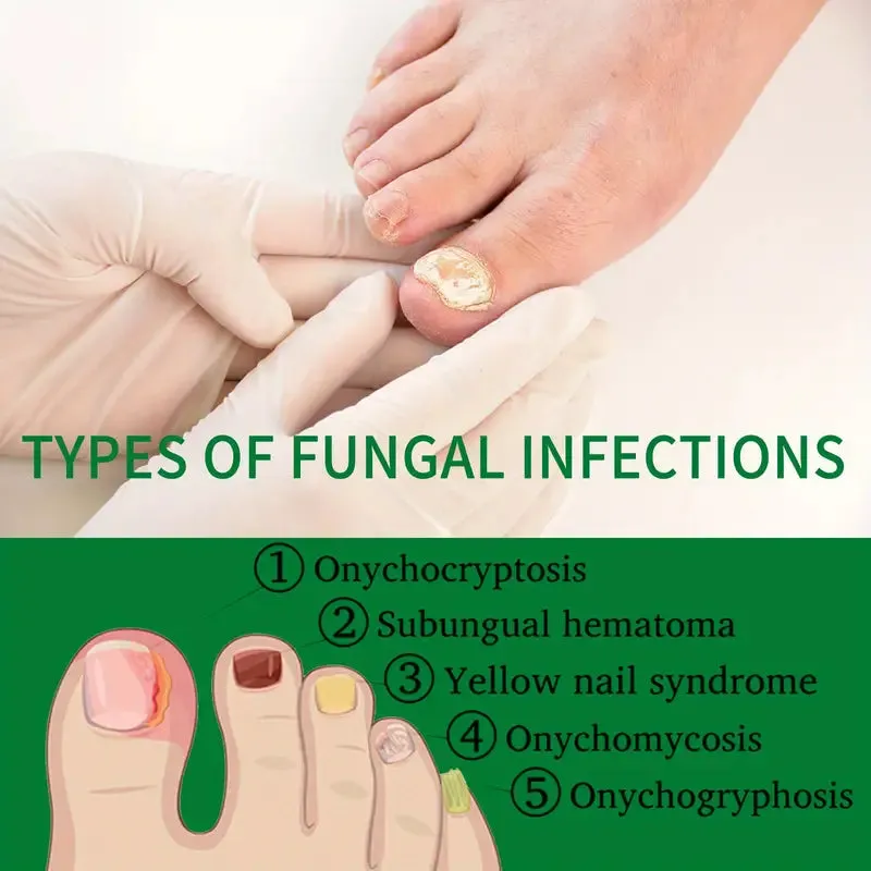 Ginger Nail Care Liquid Onychomycosis Fungus Repair Hand and Foot Nail Care